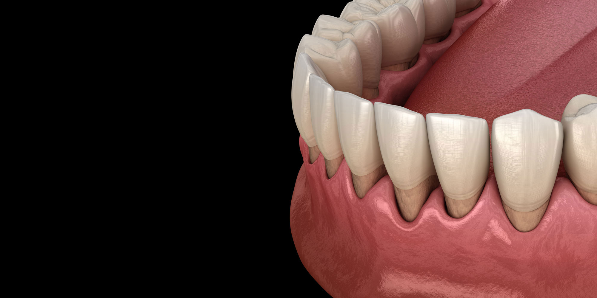 gum recession graphic