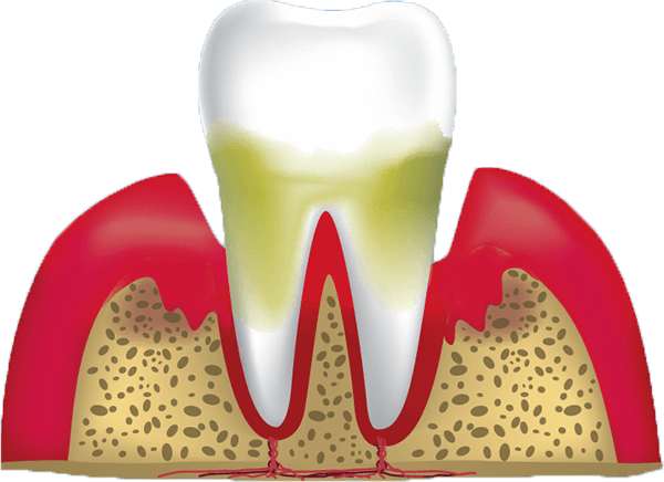 Advanced Periodontitis graphic