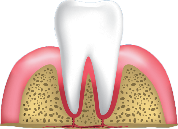 Gingivitis graphic