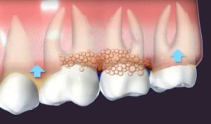 diagram-depicting-gum-disease-opt