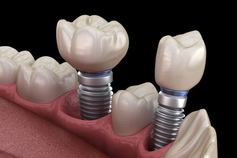 An image of a model of multiple dental implants.