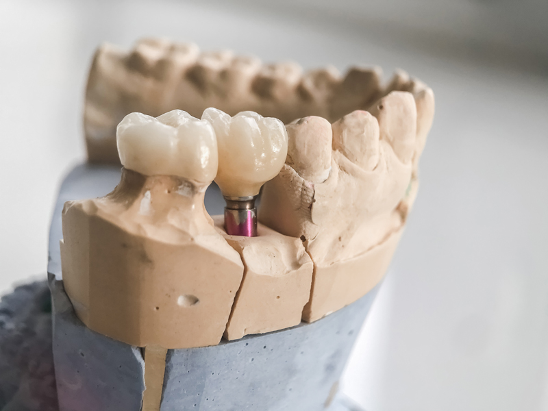 dental model of a jaw with a dental implant