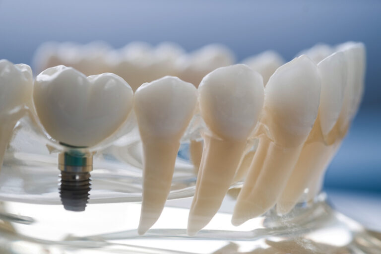 Image of a prosthesis jaw with a implant