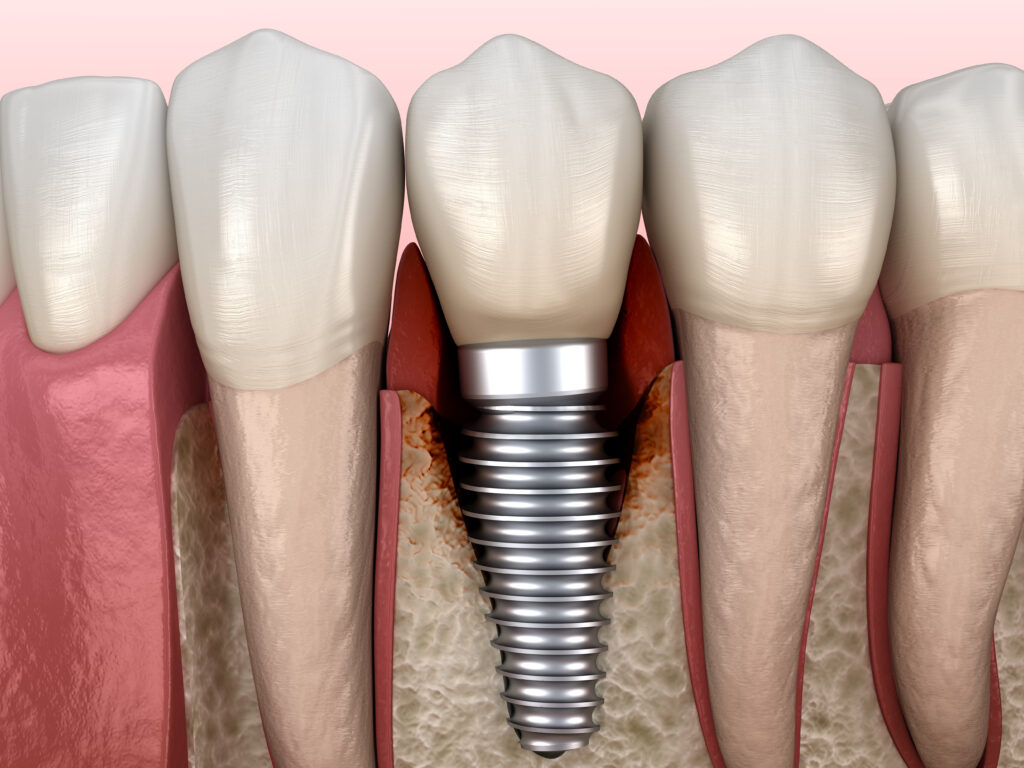 a digital model showing peri-implantitis dental implant failure.