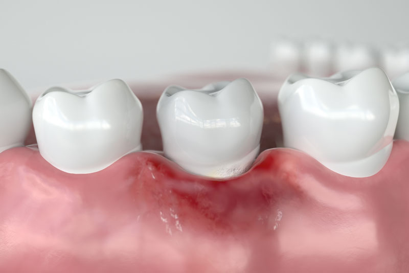 a graphic of a gumline with peri-implantitis, a failing dental implant.