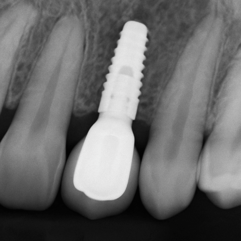 Close up X-ray image of a patient's mouth showing a successfully placed dental implant surrounded by healthy bone. No text on the image.